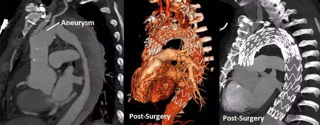 Patient scans of aortic aneurysms Patient scans of aortic aneurysms