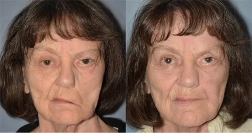 before and after facial surgery before and after facial surgery