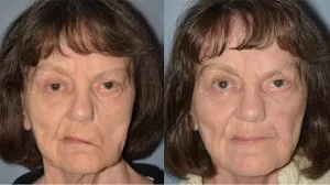 before and after facial surgery