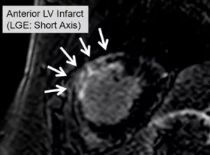 anterior LV infarct