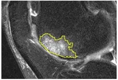 Bone marrow lesion