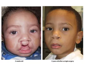 Cleft lip and palate before and after