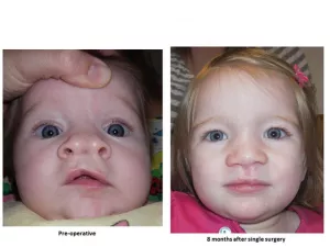 Cleft lip and palate before and after