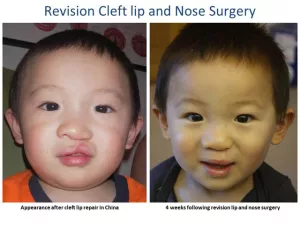 Cleft lip and palate before and after