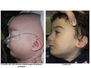 Cleft lip and palate before and after