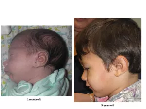 Cleft lip and palate before and after