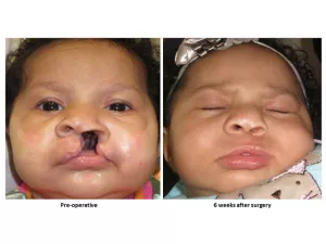 Cleft lip and palate before and after