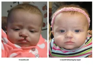 Cleft lip and palate before and after