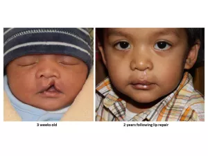 Cleft lip and palate before and after