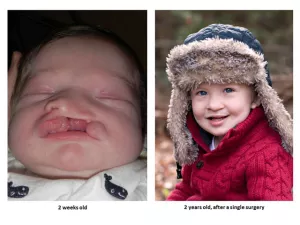 Cleft lip and palate before and after