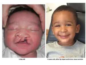 Cleft lip and palate before and after