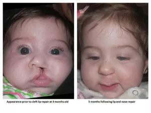 Cleft lip and palate before and after