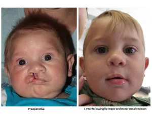 Cleft lip and palate before and after