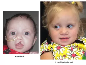 Cleft lip and palate before and after