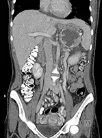 Tumor Scan