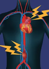 Graphic of an aortic aneurysm