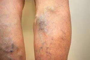 varicose veins in legs